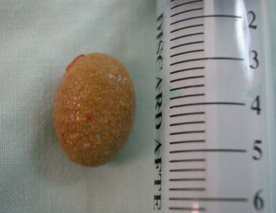 Cálculo vesical extraído junto a una jeringa como referencia de tamaño