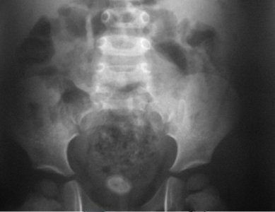 Radiografía de abdomen