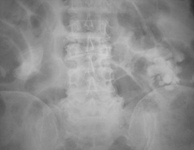 Radiografía de abdomen