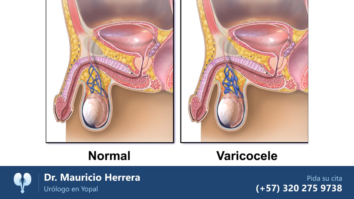Ilustración de las venas del testículo normales y con varicocele. Dr. Mauricio Herrera, urólogo en Yopal