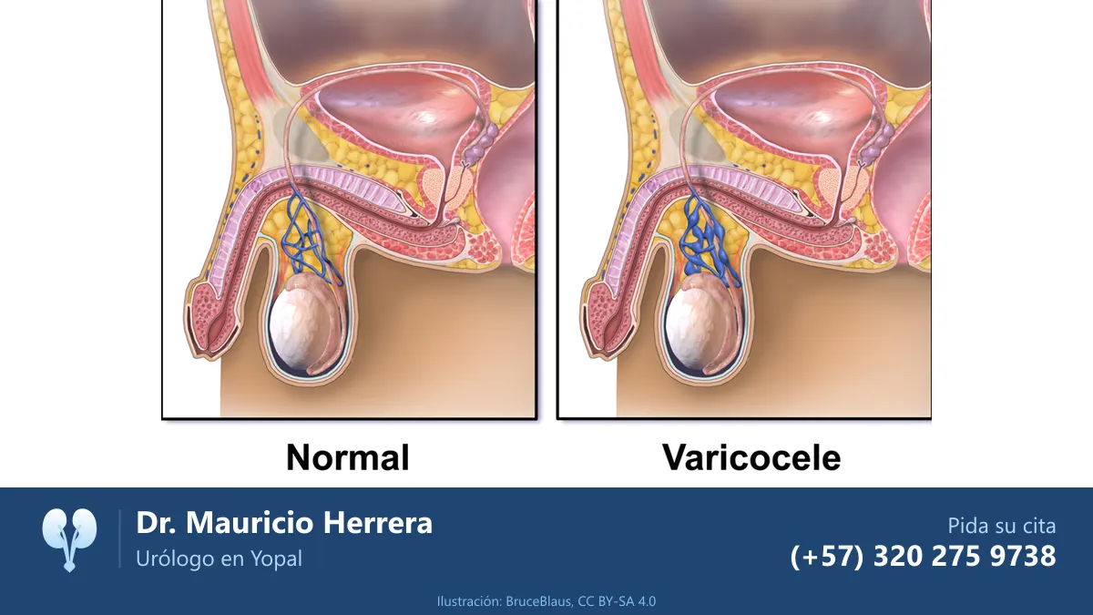 Ilustración de un testículo normal y uno con varicocele, con las venas dilatadas. Dr. Mauricio Herrera, urólogo en Yopal
